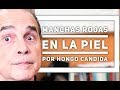 Episodio #1259 Manchas rojas en la piel por hongo cándida