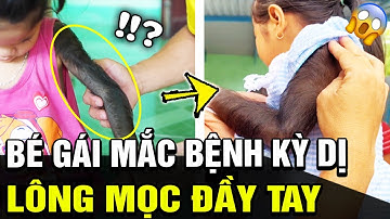 KỲ LẠ: Bé gái nghi mắc HỘI CHỨNG NGƯỜI SÓI, loại bệnh KỲ DỊ bậc nhất chưa lời giải | TB Trends