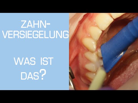 Video: Warum Zahnversiegelung?