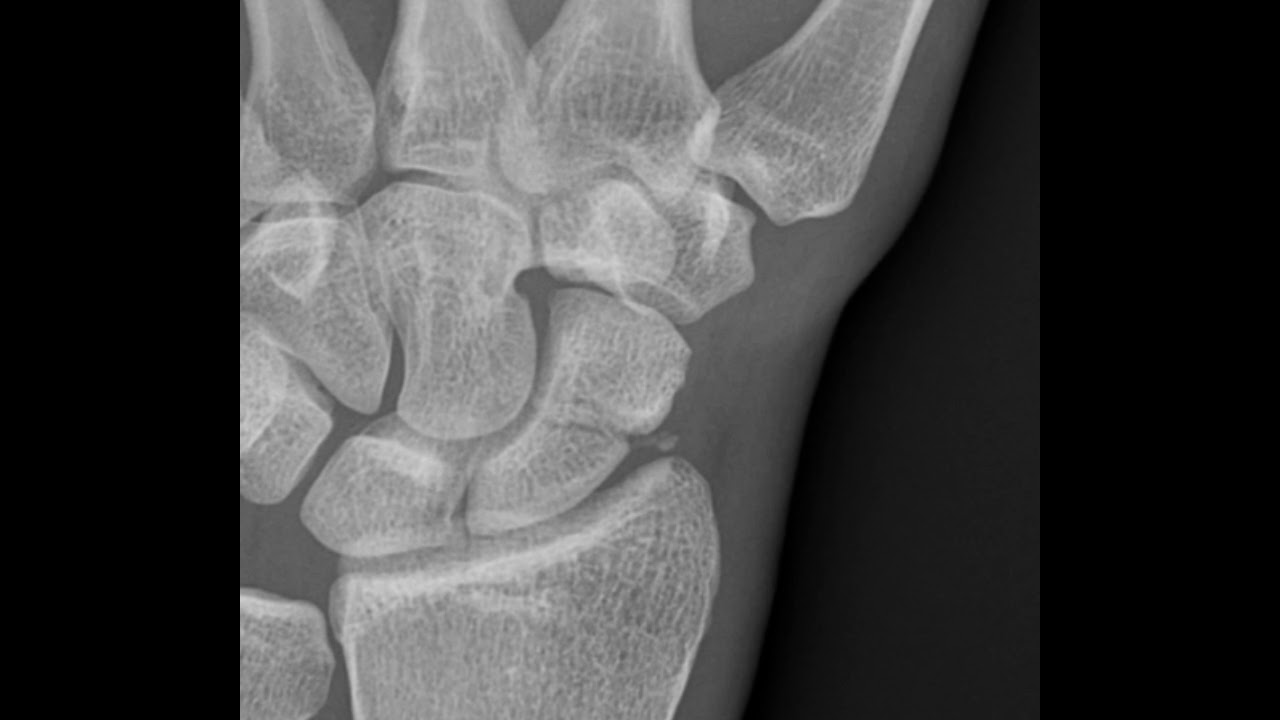Scaphoid Fracture (Xray 2) YouTube