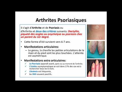 Vidéo: 8 Symptômes De L'arthrite Juvénile Idiopathique: Problèmes Articulaires Et Plus