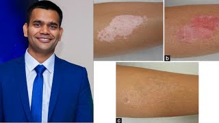 Витилиго- Белые пятна на коже / Народное лечение