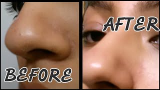 GET RID OF BLACKHEADS & OPEN PORES AT HOME 2 STEP TREATMENT- ALL NATURAL