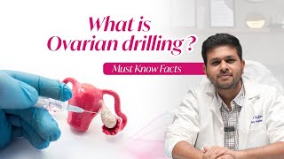What is Ovarian Drilling? | Must-Know Facts for Women with PCOS