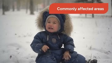 Frostbite  Symptoms and Dangers