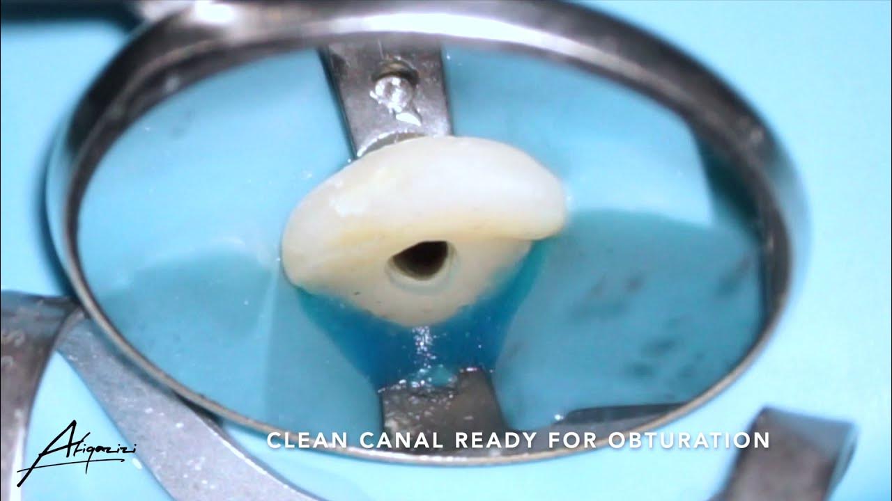 Root canal treatment on the maxillary central incisor (tooth 21) YouTube