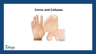 Corns and Calluses