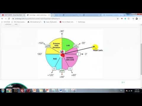 Video: Ürək böhranı ekg-də görünür?