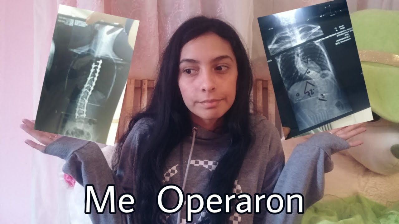 Me operaron | Escoliosis hdri