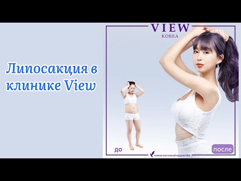 Липосакция тела в клинике View. До и После. Пластика в Корее