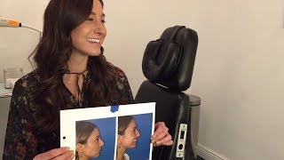 NYC Rhinoplasty Before and After with Top Plastic Surgeon Dr. Barry Weintraub