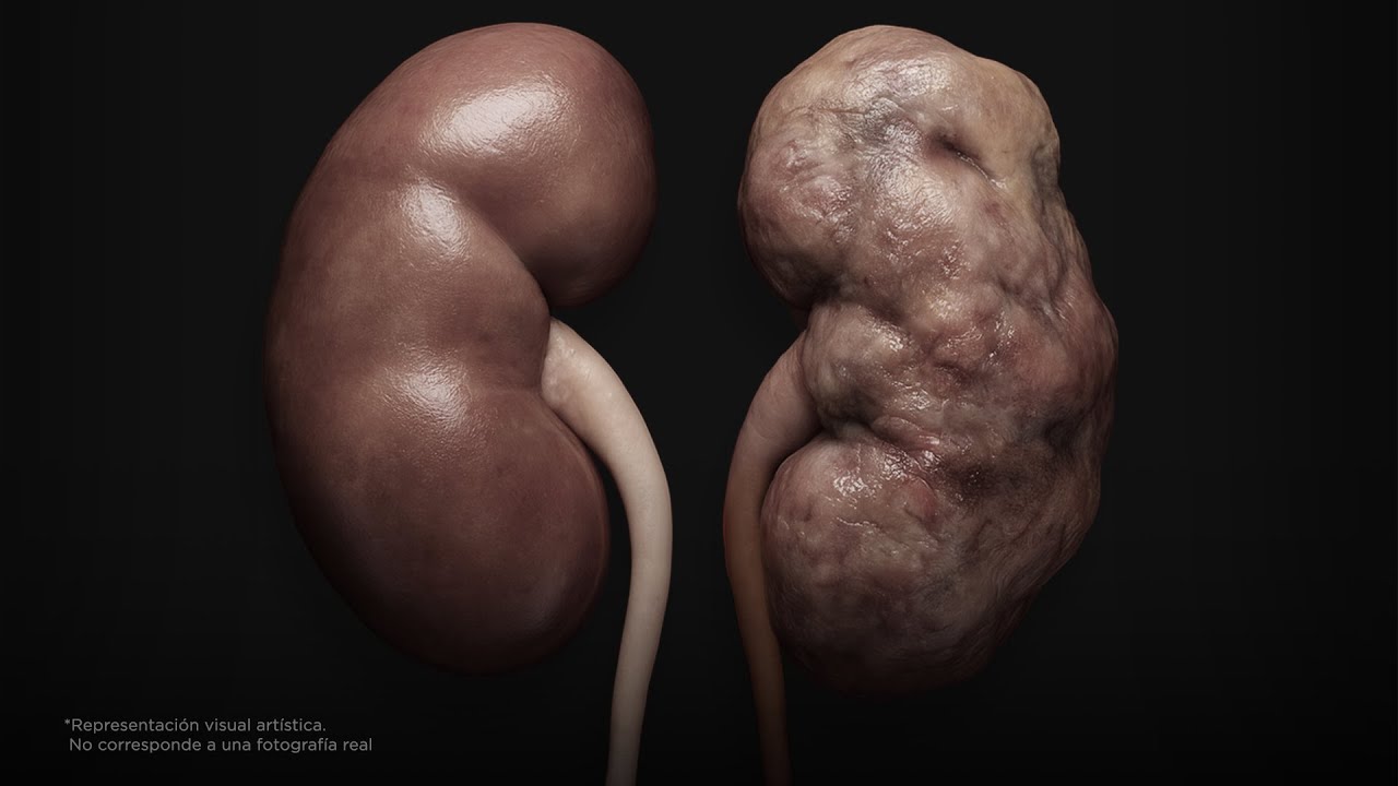 Esto le pasa a tus riñones si tomas poca agua