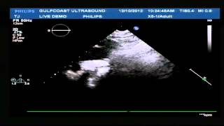 Hot Tips - Finding the Aortic Arch with Ultrasound