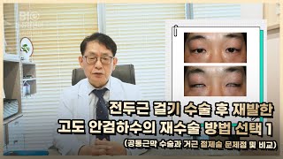 전두근 걸기 수술 후 재발한 고도 안검하수의 재수술 방법 선택 1(공통근막 수술과 거근 절제술 문제점 및 비교) - 비아이오성형외과 홍성표원장