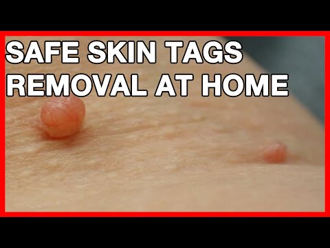 How To Cure Skin Tags On Face, Eyes, Shoulders, Armpits