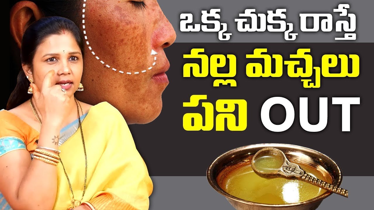 Vanaja Ramisetty About Pigmentation | Remove Black Spots, Acne and Pimples from Face | SumanTv Mom
