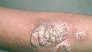 Psoriasis and how to treat: TMI TUESDAYS