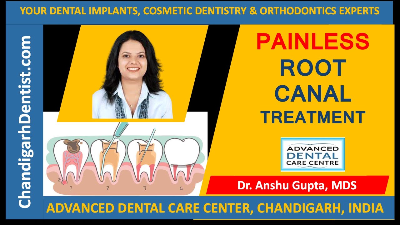 Best Root Canal Treatment dentist Chandigarh, Punjab, India | Cost root canal treatment Chandigarh