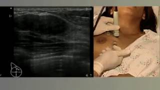 Cryoablation video