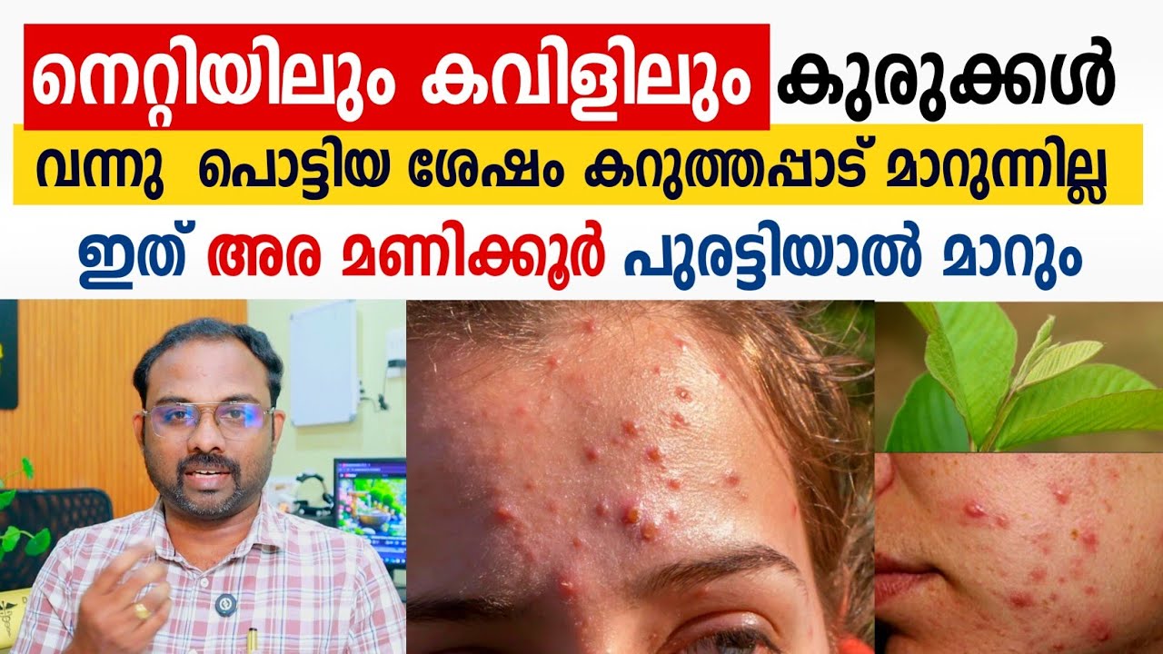 നെറ്റിയിലും കവിളിലും കുരുക്കൾ ഉണ്ടാകുന്നത് പൂർണമായി മാറും ✅ ഒരുപ്രാവശ്യം ഇതുപോലെ ചെയ്താൽ മതി 🧑🏻‍⚕️💯