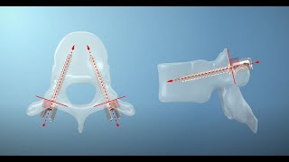 Free hand technique for pedicle screw