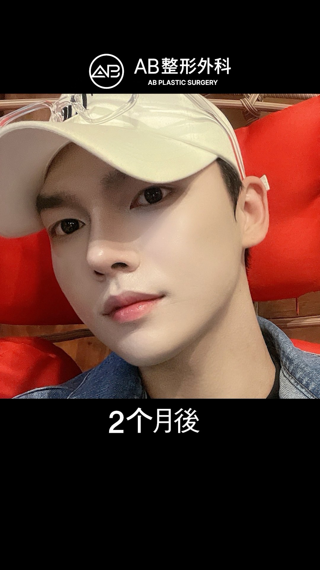 男生眼鼻輪廓全整形！前後對比震撼公開 #shorts
