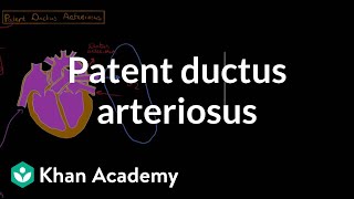 Patent ductus arteriosus | Circulatory System and Disease | NCLEX-RN | Khan Academy