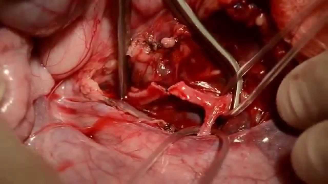 arterial anastomosis youtube anastomosis