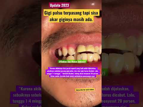 Video: Bisakah Anda membuat gigi palsu tanpa bekas?