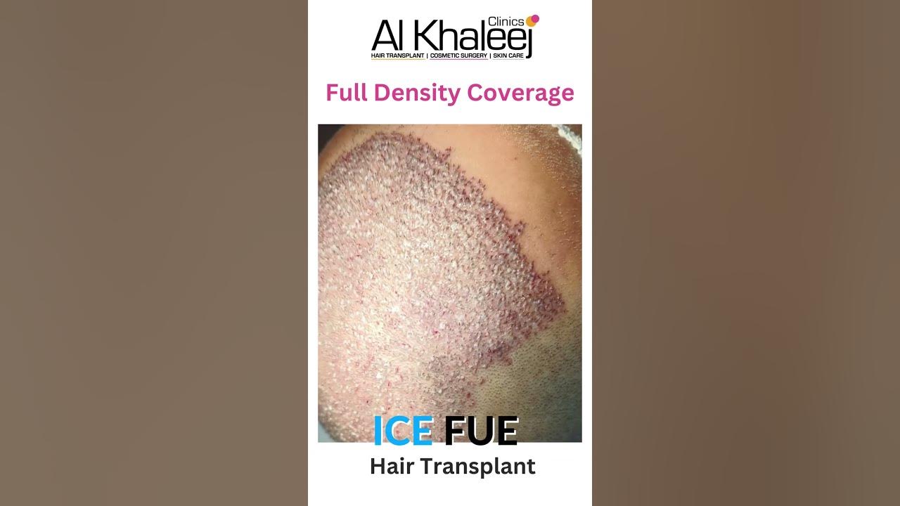 ice-fue-hair-transplant-full-density-coverage-case-updates-youtube