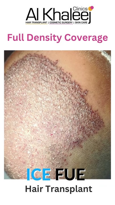 ICE FUE Hair Transplant Full Density Coverage Case Updates YouTube ice-fue-hair-transplant-full-density-coverage-case-updates-youtube