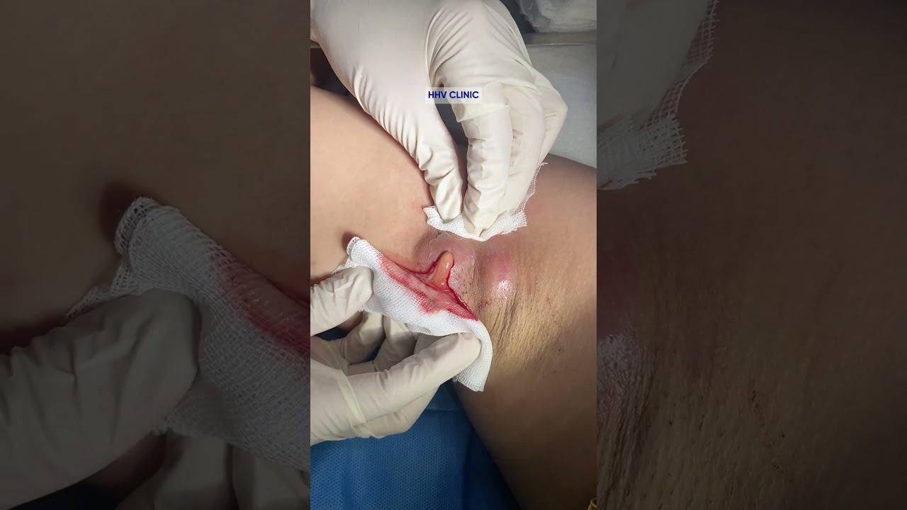 Mụn nhọt ở nách sưng to, chứa ổ mủ sâu – bác sĩ khử viêm và làm sạch ổ nhiễm.