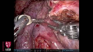 Download Lagu Whipple Procedure with Situs Inversus Anatomy MP3 Download Lagu Whipple Procedure with Situs Inversus Anatomy MP3