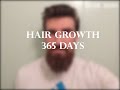 Hair Growth Time Lapse - One Year