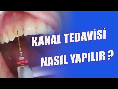 Video: Diş hekiminde tedavinin son aşaması