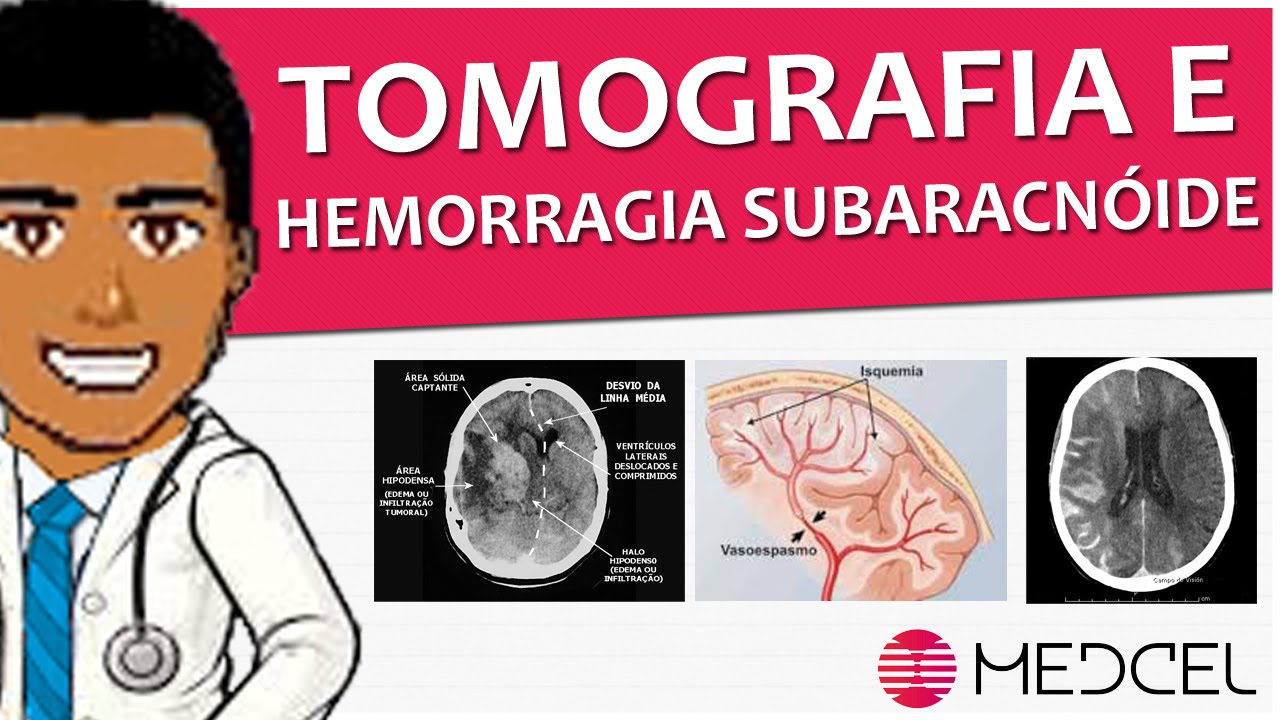 fisiologia patologica Radiologia - Tomografia de Crânio e achados da Hemorragia Subaracnoide + Sorteio (MEDCEL)