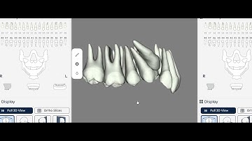 Segmentation of impacted canine . Using AI assisted Relu software.