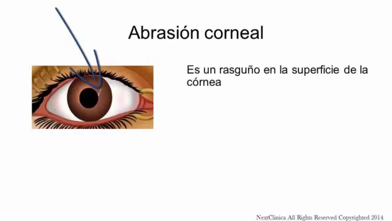 Corneal abrasion Spanish YouTube