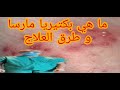 ما هي بكتيريا مارسا المكورات العنقودية الذهبية المقاومة للميثيسيلين و العلاج ما هي بكتيريا مارسا المكورات العنقودية الذهبية المقاومة للميثيسيلين و العلاج