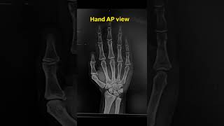 Hand Ap &amp; oblique view.       #radiology #xray #shortsfeed #radiologydiagnostichub
