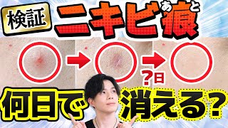 【ニキビ跡何日で消える？】巨大にきびの色素沈着が完全消失するまでどれくらいかかるか検証してみた