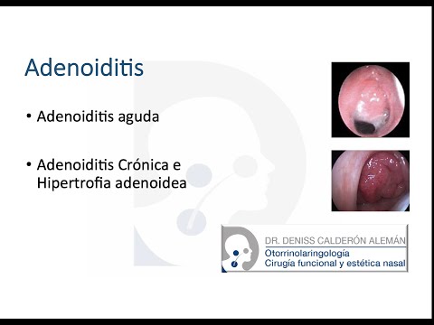 Vídeo: Adenoiditis Aguda Y Crónica: Síntomas, Tratamiento, Adenoiditis En Niños