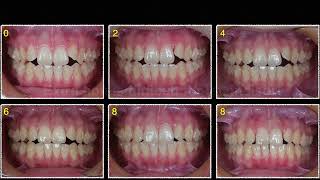 Extruding Maxillary Lateral Incisors with Clear Aligners｜【Chris Chang Ortho】555