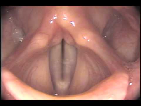 Stroboscopy Rigid Normal female vocal cords   glide up