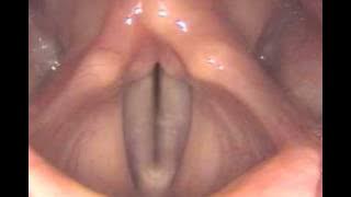 Stroboscopy: Rigid: Normal female vocal cords - glide up