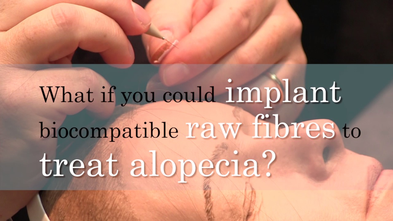Biofibre Hair Implant for Hair Loss Intervention YouTube