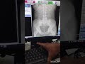 LS spine ka X ray Konica CR per kaise krte hai # radiology