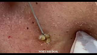 Popping Tons Of Blackheads Part 02