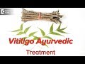 How can we treat vitiligo(white patches)through Ayurveda? - Dr. Mini Nair