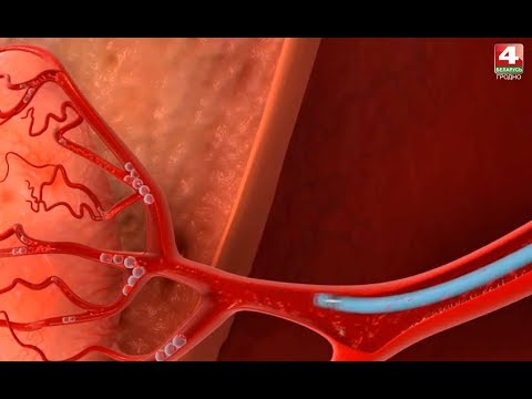 Video: Koronárna Angiografia: Príprava, Postup A Výsledky